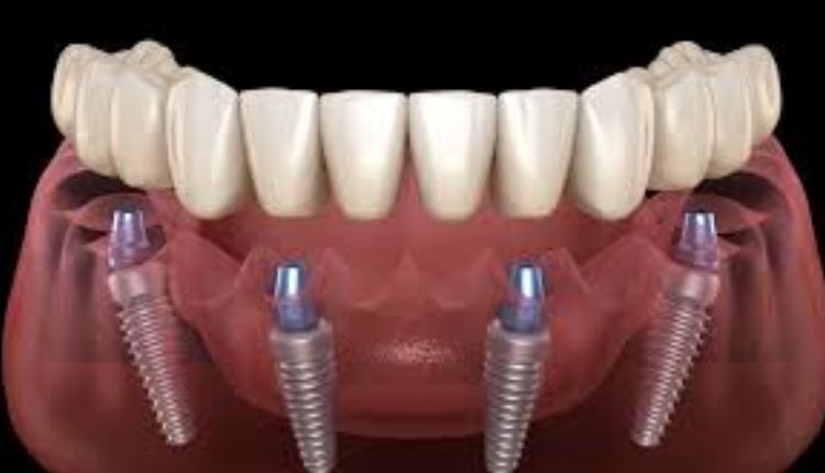 What Are All-on-4 Dental Implants? Dental
